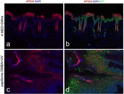 Pathogenesis of Skin Carcinomas and a Stem Cell as Focal Origin